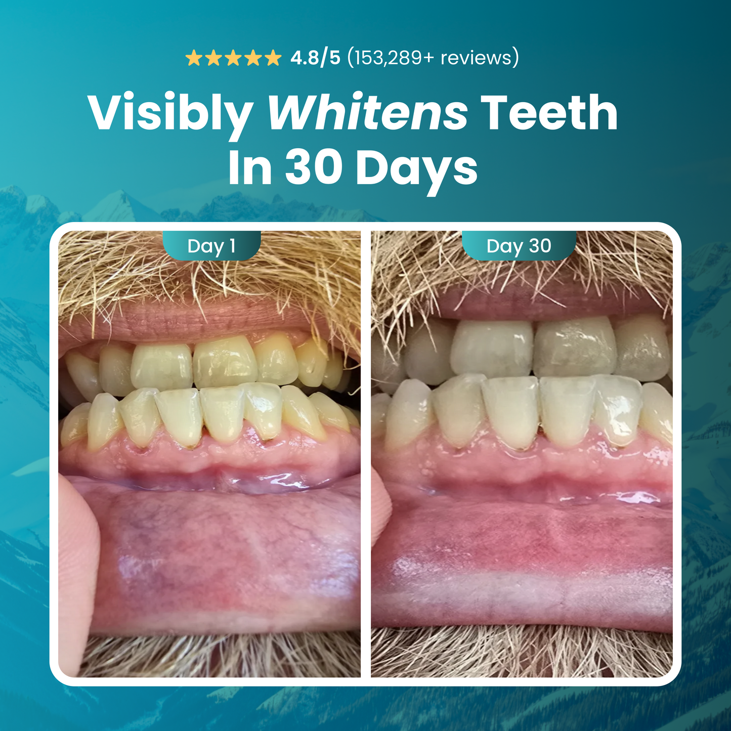 Side-by-side image of teeth before and after whitening treatment.