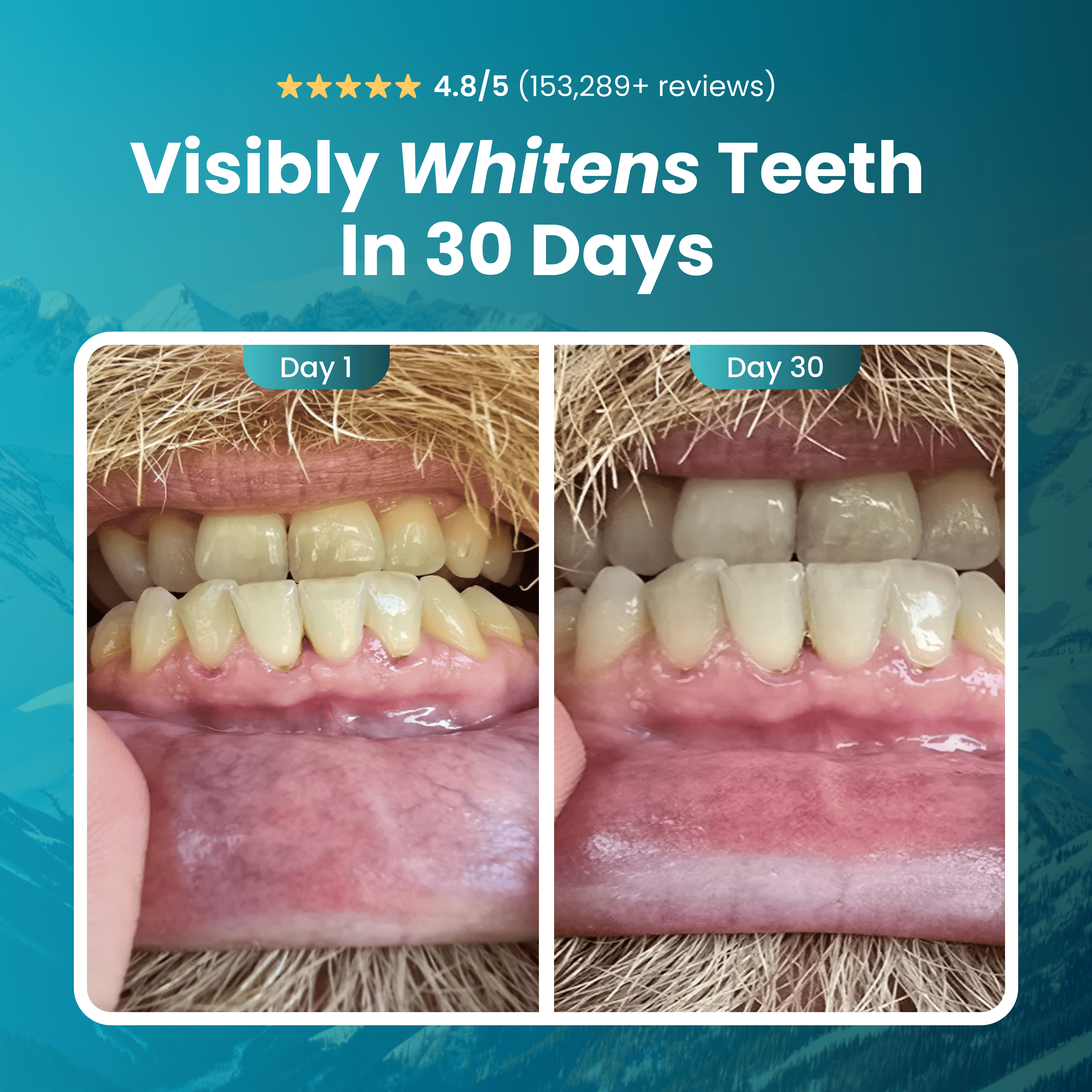 Teeth whitening before and after 30 days (Image2_ef76b73e)