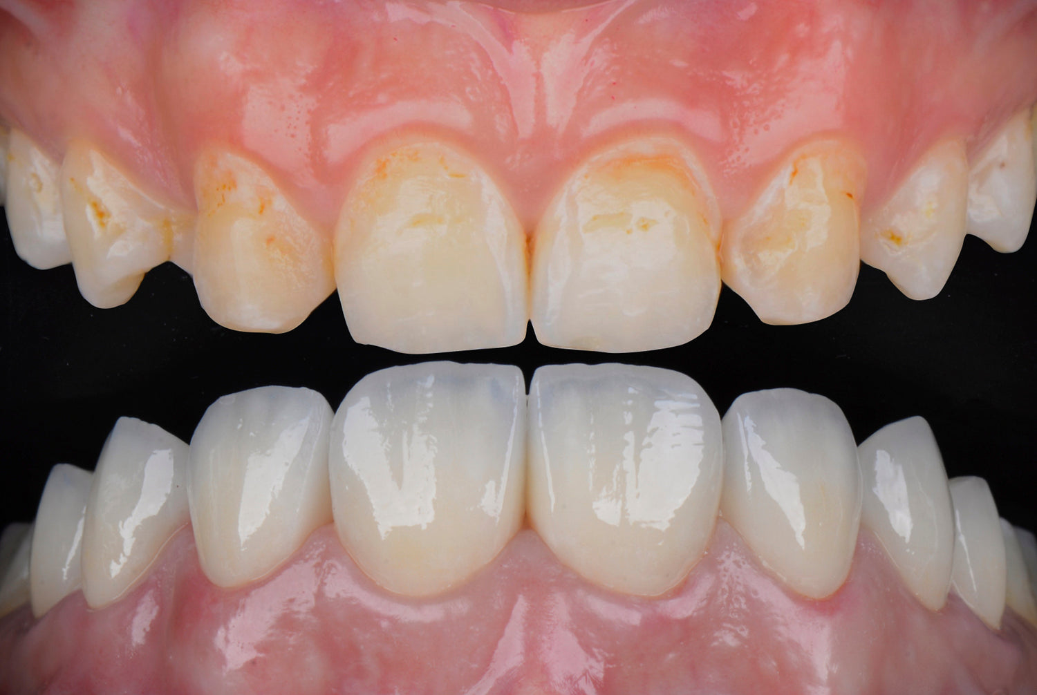 before and after smile makeover